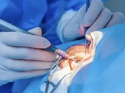 Microincision Cataract Surgery